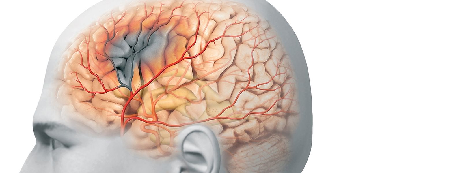 Hirnstimulation Verbessert Sprechen Nach Schlaganfall