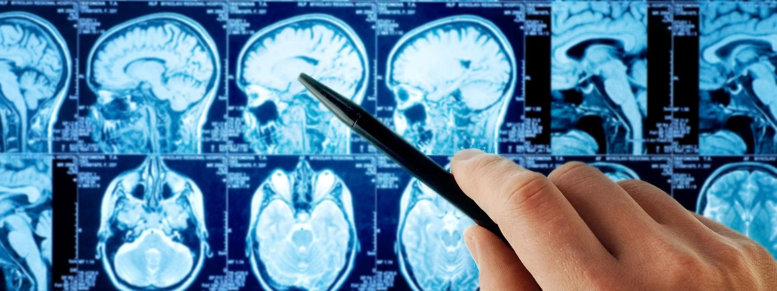 Sowohl bei der Creutzfeldt-Jakob-Krankheit als auch bei Alzheimerdemenz werden Hirnzellen zerstört.