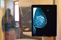 ARCHIV - 25.10.2017, Sachsen-Anhalt, Magdeburg: Die Brust einer Frau ist auf einer Röntgenaufnahme zu sehen. (zu dpa «Hormontherapien erhöhen das Brustkrebsrisiko langfristig») Foto: Klaus-Dietmar Gabbert/zb/dpa +++ dpa-Bildfunk +++