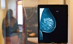 ARCHIV - 25.10.2017, Sachsen-Anhalt, Magdeburg: Die Brust einer Frau ist auf einer Röntgenaufnahme zu sehen. (zu dpa «Hormontherapien erhöhen das Brustkrebsrisiko langfristig») Foto: Klaus-Dietmar Gabbert/zb/dpa +++ dpa-Bildfunk +++