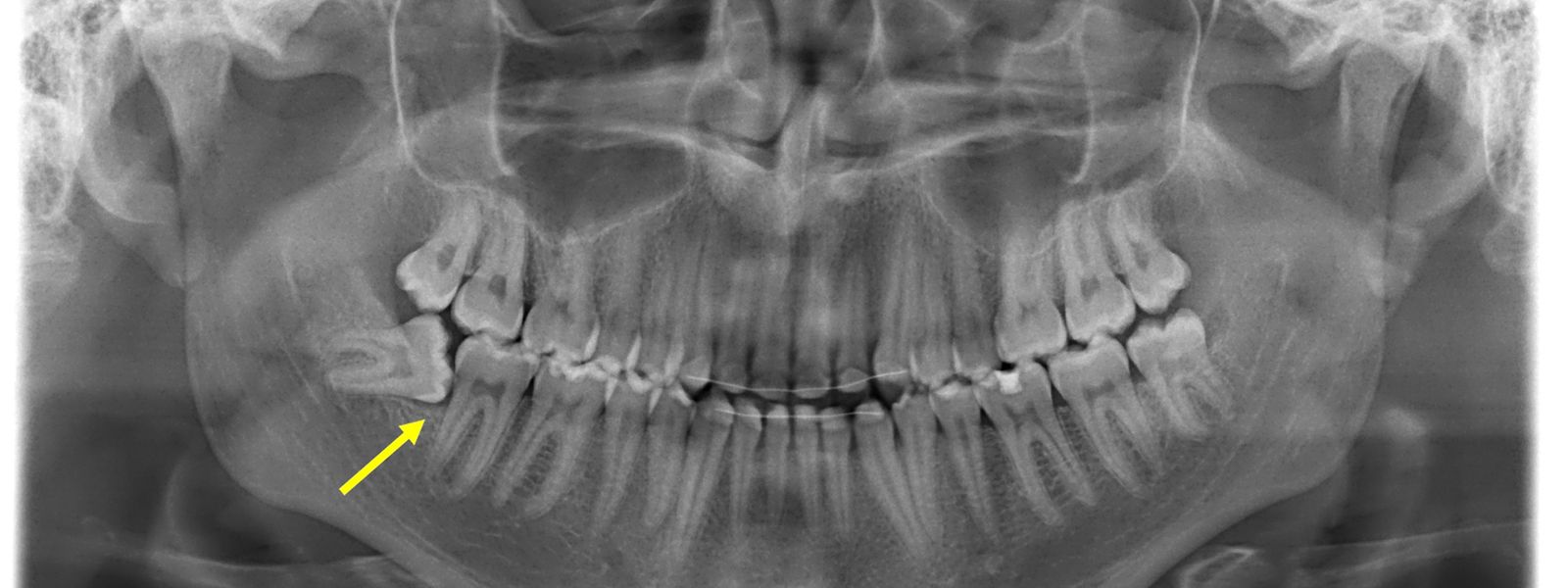 26+ inspirierend Bilder Wann Müssen Weisheitszähne Entfernt Werden - Weisheitszähne im Fakten-Check: Das sollten Sie wissen - Weisheitszähne müssen nicht generell entfernt werden.