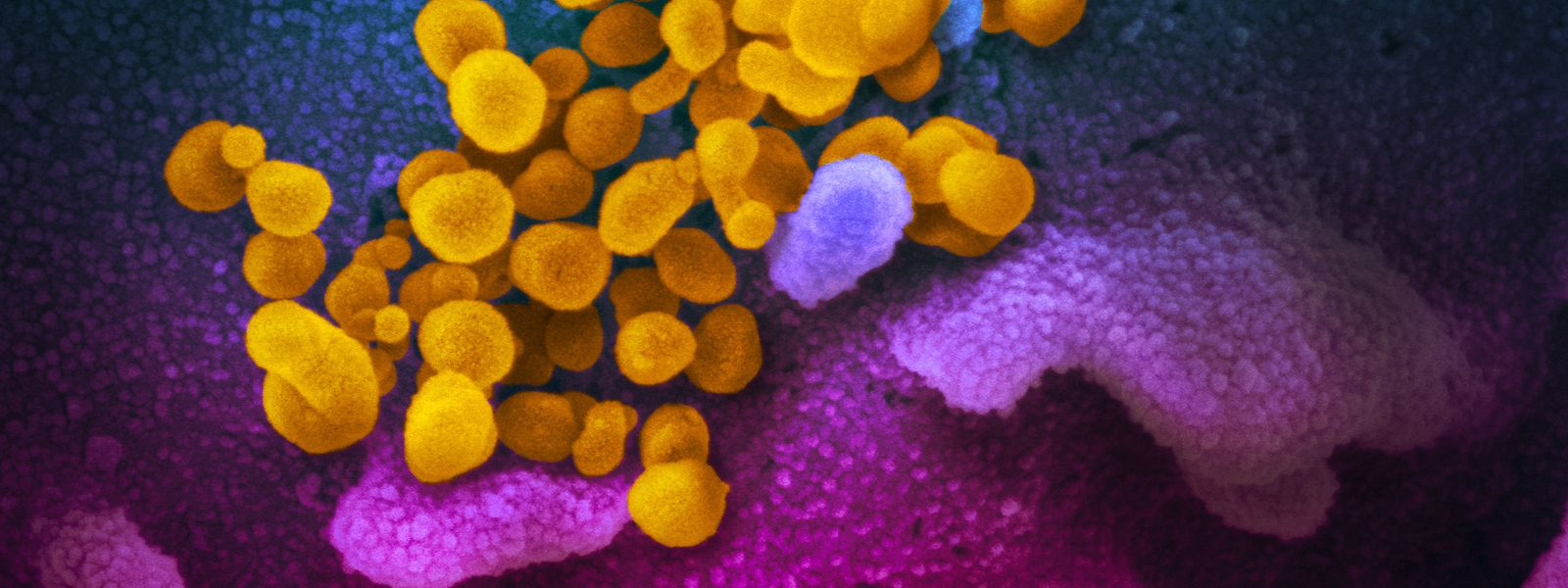 Eine Falschfarbendarstellung zeigt wie SARS-CoV-2-Viren (gelb gefärbt) aus einer Wirtszelle austreten.
