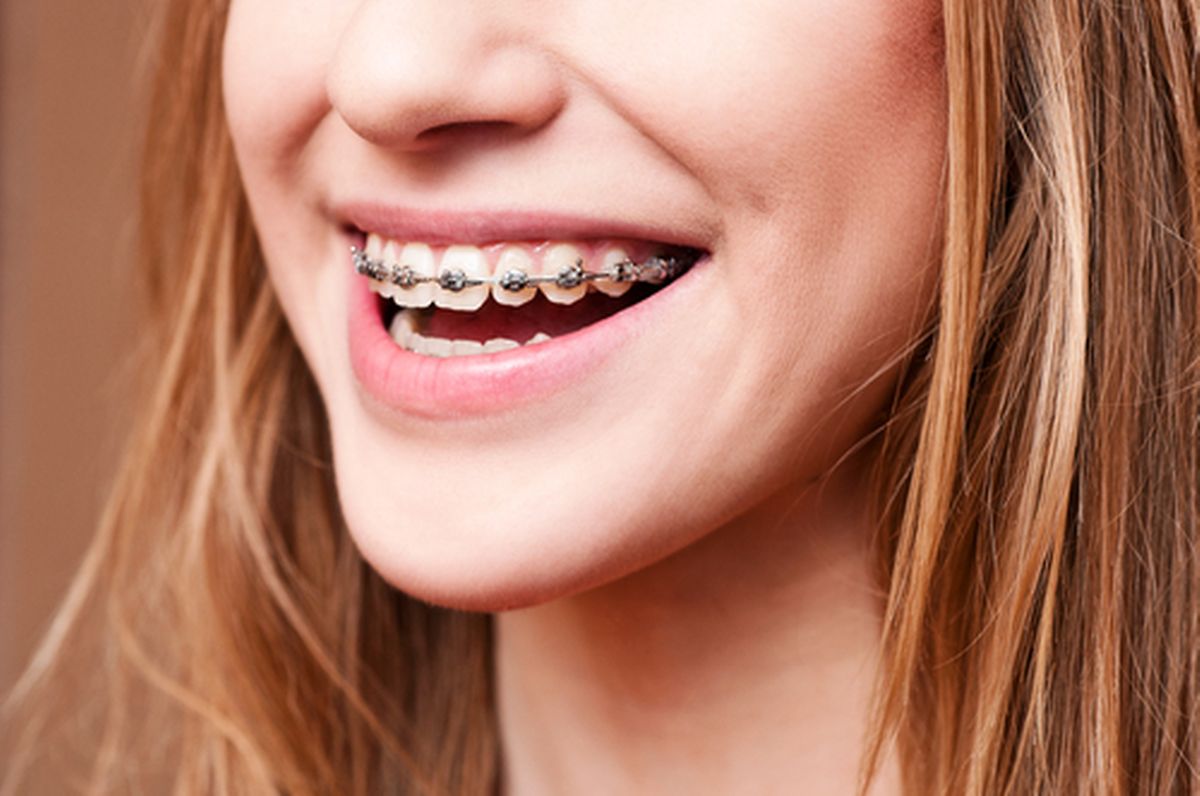 Orthodontic treatment is fully covered by the CNS for those aged 17 or under Photo: Shutterstock