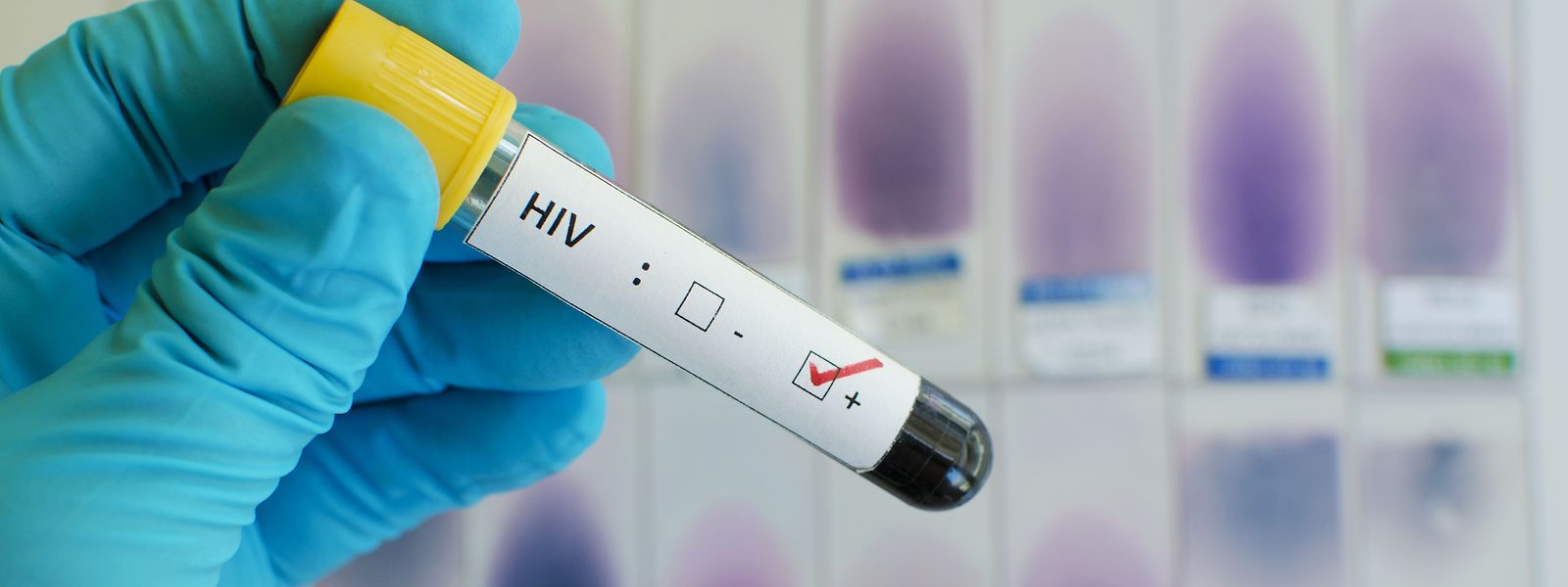 Le VIH continue de circuler au Luxembourg et la crise sanitaire a par ailleurs entraîné pas mal de retards dans les dépistages.
