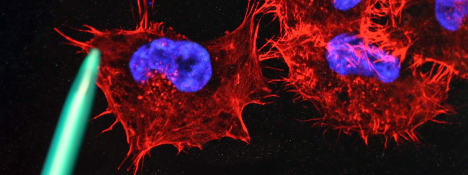 Im Labor des Instituts für Experimentelle Gentherapie und Tumorforschung (IEGT) der Universitätsmedizin Rostock schaut eine Doktorandin auf einen Monitor, auf dem ein Bild von Melanom-Zellen (schwarzer Hautkrebs) zu sehen ist.