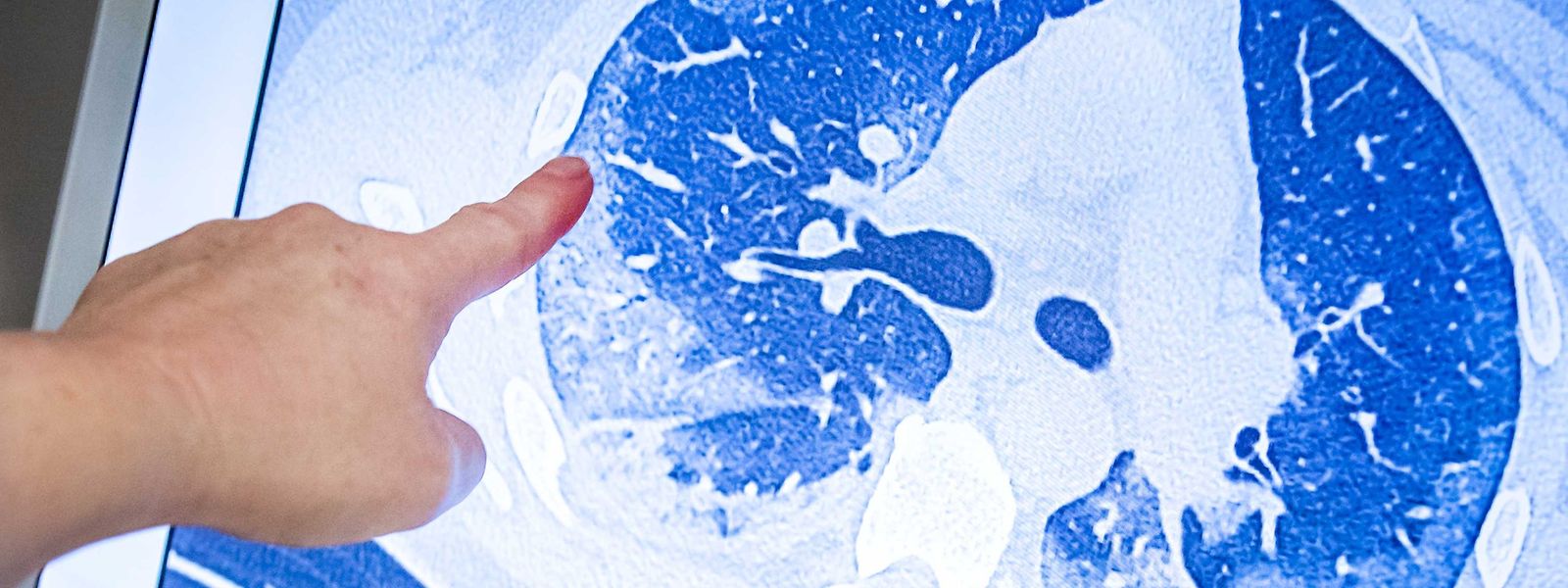 Eine Scanner-Aufnahme der Lunge eines Patienten, der sich mit dem Coronavirus infiziert hat.