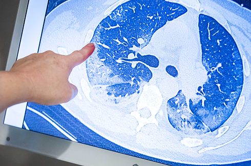 ARCHIV - 03.04.2020, Niederlande, Den Haag: Ein behandelnder Arzt zeigt auf die CT-Aufnahme der Lunge eines Patienten, der sich mit dem Coronavirus infiziert hat. (zu dpa "Wohl Covid-19-Spätfolgen wie vermindertes Lungenvolumen möglich") Foto: Remko De Waal/ANP/dpa - ACHTUNG: Nur zur redaktionellen Verwendung im Zusammenhang mit einer Berichterstattung über das Coronavirus +++ dpa-Bildfunk +++