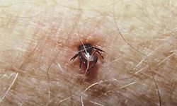 Bisher konnte noch kein Impfstoff gegen die Lyme-Borreliose entwickelt werden.