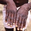 This handout photo provided by the Centers for Disease Control and Prevention was taken in 1997 during an investigation into an outbreak of monkeypox, which took place in the Democratic Republic of the Congo (DRC), and depicts the dorsal surfaces of a monkeypox case in a patient who was displaying the appearance of the characteristic rash during its recuperative stage. (Photo by Brian W.J. Mahy / Centers for Disease Control and Prevention / AFP) / RESTRICTED TO EDITORIAL USE - MANDATORY CREDIT "AFP PHOTO /  Brian W.J. Mahy / Centers for Disease Control and Prevention " - NO MARKETING - NO ADVERTISING CAMPAIGNS - DISTRIBUTED AS A SERVICE TO CLIENTS