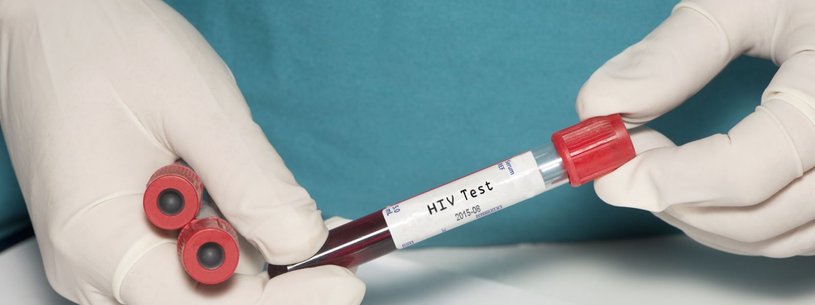 HIV-Infektionen können durch Tests frühzeitig erkannt werden.