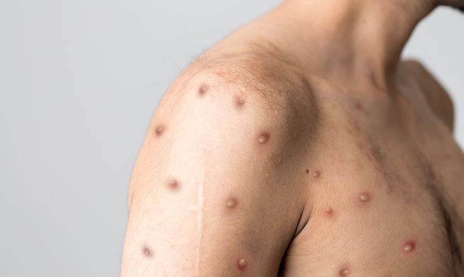 One of the most common symptoms is a rash