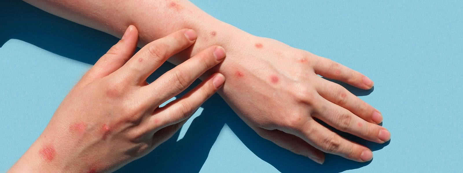 Un premier cas d'une femme contaminée par le virus de la variole du singe a été enregistré en Belgique.