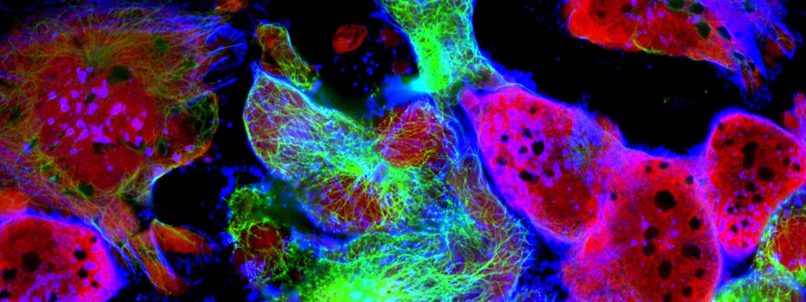 Tumorzellen unter dem Mikroskop: Am Weltkrebstag rückt eine der häufigsten Todesursachen weltweit in den Vordergrund.